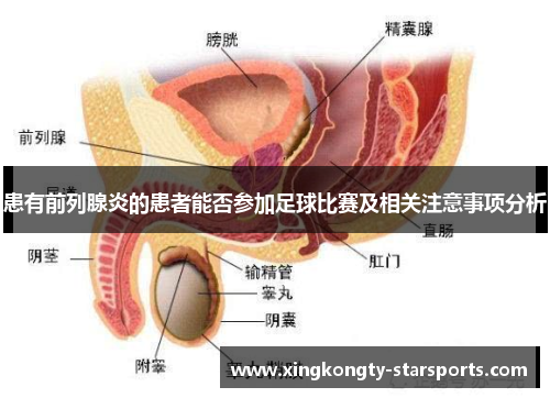 患有前列腺炎的患者能否参加足球比赛及相关注意事项分析